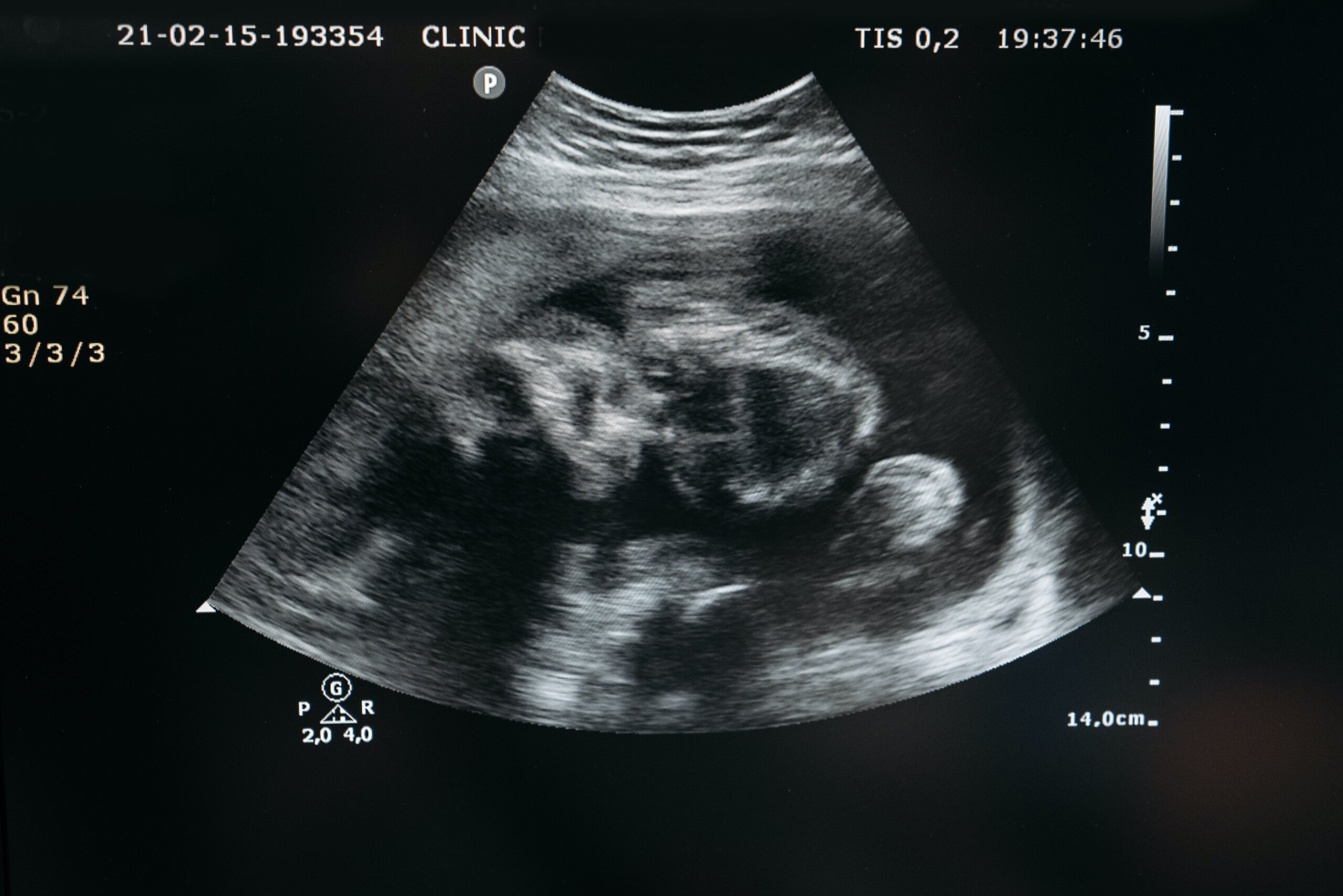 personapraktijk.nl/blog/prenatale stress en de foetus